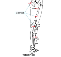 坐骨神經痛理療儀