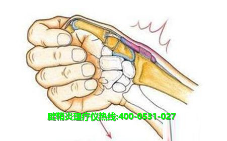 腱鞘炎治療儀 腱鞘炎治療儀