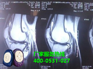 膝關節滑膜炎治療儀 膝關節滑膜炎治療儀