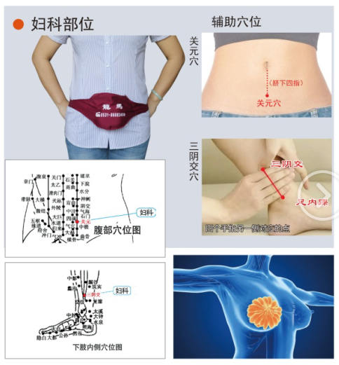 盆腔炎治療儀